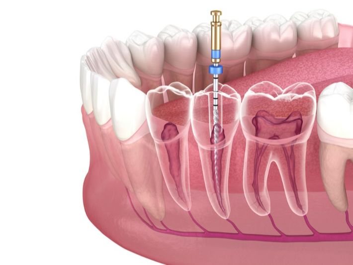 تعرف على مدة الألم بعد حشو العصب وكيفية التعامل معه بفعالية. اكتشف الأسباب المحتملة لاستمرار الألم وأفضل طرق تخفيفه للتعافي السريع والناجح